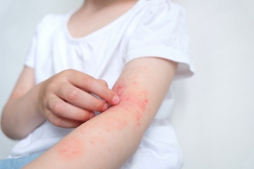 Lanzan plataforma digital educativa para personas que viven con dermatitis atópica