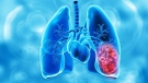 Estudio revela resultados de tratamiento que frena progresión en cáncer de pulmón 