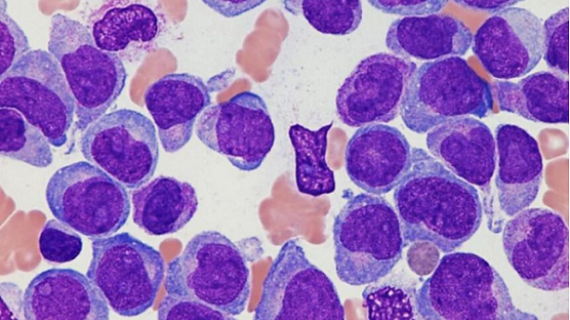 Novartis lanza nueva terapia para pacientes con Leucemia Mieloide Crónica